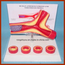 New Desktop Education Anatomy Human Disease Anatomical Model Artery for Patient